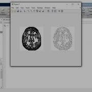 MRI BRAIN IMAGE SEGMENTATION BY MULTI RESOLUTION EDGE DETECTION AND REGION SELECTION