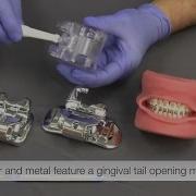 Empower Braces Open Close Techniques