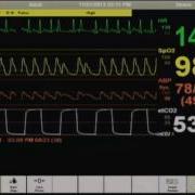 Cardiac Arrest Patient Monitor