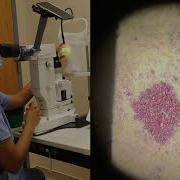 Principles Of Laser Surgery On Model Eye LPI And SLT