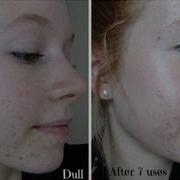 Personal Microderm Review PMD Demo And Before After Pictures