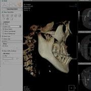 3D Ceph Superimposition