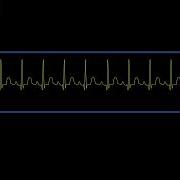 Tachycardia Rhythm Waveform Simulated Patient Waveform
