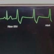 Simulated Waveforms From Patient Simulator