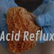What Is Acid Reflux