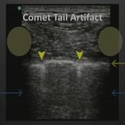 Ultrasound Artifacts