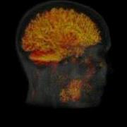 Spectus3D MRI Head Brain Extraction