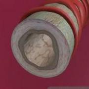 Understanding Asthma 360p Animation