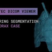 Сontouring Segmentation In Inobitec DICOM Viewer Pro Hemothorax Сase
