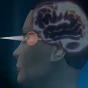 What Is Glaucoma Explained Using Animation