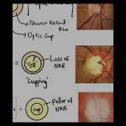 Normal Disc Vs Glaucomatous Disc Vs Atrophic Disc Basics Shorts