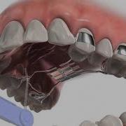 Expander Animation