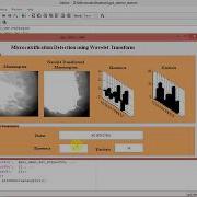 Micro Calcification Detection Using Wavelet Transform Full Matlab Code Final Year Project