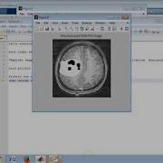 Medical Image Fusion Based On DWT And SPIHT Techniques With Quantitative Analysis