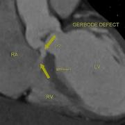 Gerbode Defect