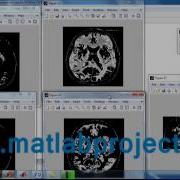 Brain MS Segmentation Image Proceesing Matlab Projects