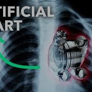 Permanent Artificial Hearts Are Closer Than You Think