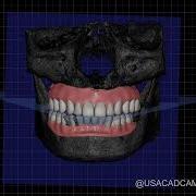 Exocad Articulator Dynamic Occlusion Digital Integration