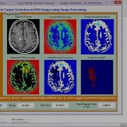 Brain Tumor Detection Using Image Processing Full Matlab Project Code Brain Tumor Classification