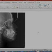Using Powerpoint To Draw Ceph Superimpositions