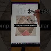 Draw Memorize The Visual Field Defects In 60s Medstudent Premed Anatomy Anatomyclass