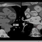Cardiac Angio Anatomy CT Cardiac Angio Medicos1k86 Radiology Medical Heart Video Angio Ct