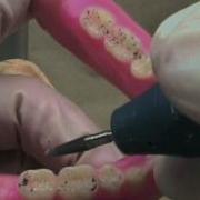 36 Lateral Contacts Lingualized Occlusion