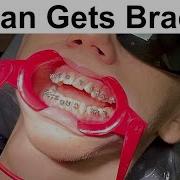How Braces Are Put On