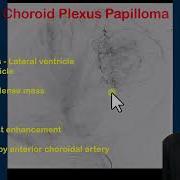 Choroid Plexsus Papilloma