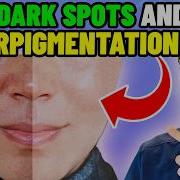 5 Ways To Get Rid Of Hyperpigmentation Melasma And Spots