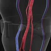 3D Illustration Of A Tourniquet Stopping Blood Flow