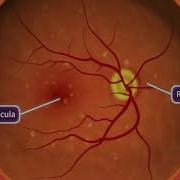 Animation Age Related Macular Degeneration