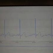 ECG Live Data From AD8232 And Arduino