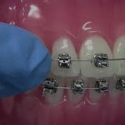 How To Manage A Open Bracket Orthodontic Emergency