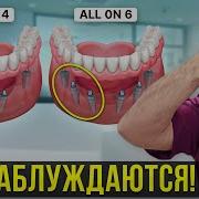 Вся правда об имплантации ВСЕ НА 4 и ВСЕ НА 6 Об этом молчат все стоматологи