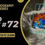 ECHO CASE 72 Echocardiography For Beginners Echo Spot Diagnosis Series Cardiology