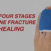 The Four Stages Of Bone Fracture Healing