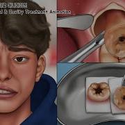 ASMR Wisdom Tooth Cavity Treatment Animation Full Ver Teeth Whitening