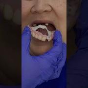 Flexible Dentures How To Fix A Dentures Dentures