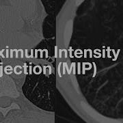 Что происходит с MIP