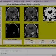 Matlab Code For Brain Tumor Detection Using Image Processing