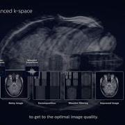 Philips Compressed SENSE How Does It Work