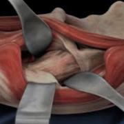 Learn About Anterior Approach Total Hip Replacement