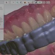 How To Design And Print An Occlusal Splint Using 3Shape