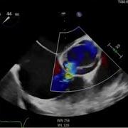 Acquired Gerbode Defect In A Patient With Infective Endocarditis Of Bicuspid Aortic Valve