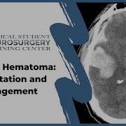 Subdural Hematoma Presentation And Management