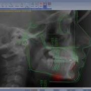 Visual Treatment Objective In Planmeca Romexis Cephalometric Analysis Module