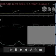 Intro To Ventisim With SimVS