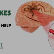 Ischemic Hemorrhagic Strokes Symptoms And Treatment Adult First Aid EMT First Aid Training