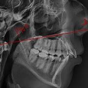 05 Utilization Of Palatal Maxillary Plane Cephalometric Analysis